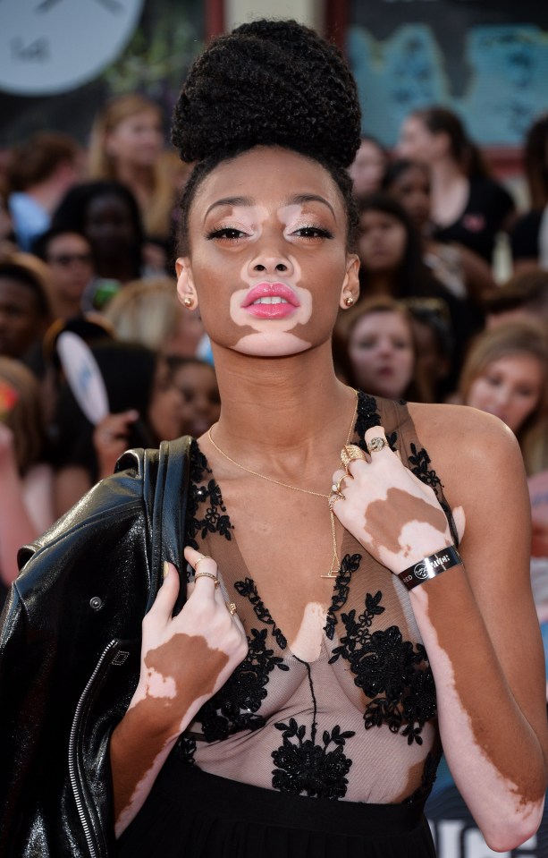  Model behaviour . . . Winnie Harlow said kids called her a 'cow' because she has vitiligo