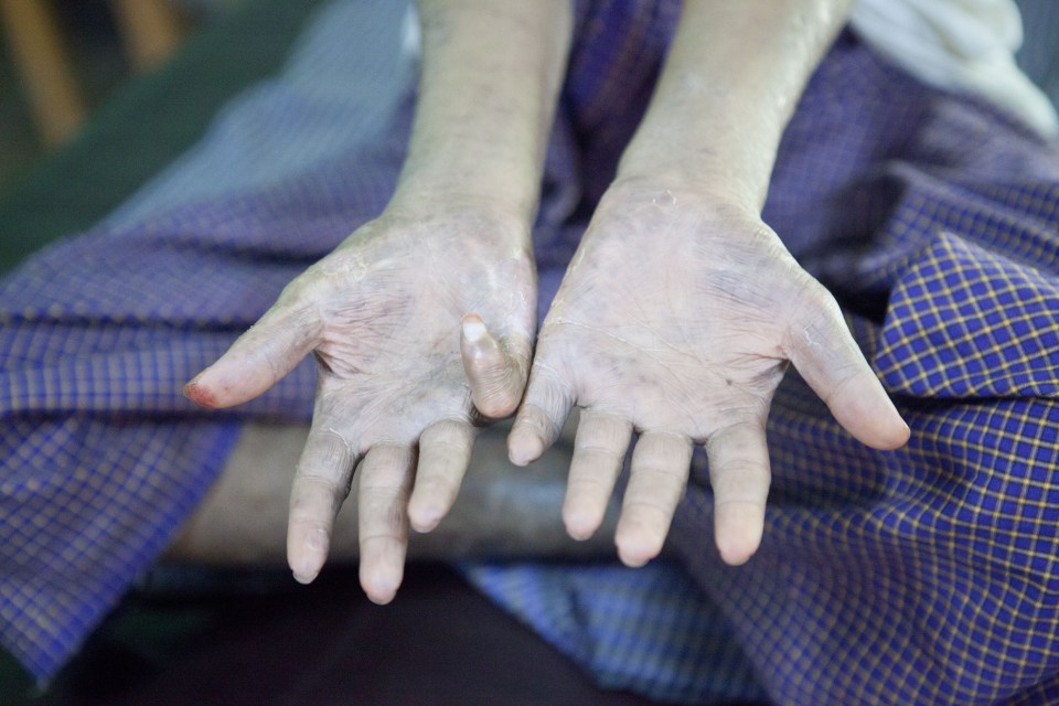  Leprosy causes the sufferer to lose feeling in their limbs