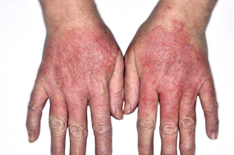  Sore hands . . . ask your GP to take another look at skin trouble