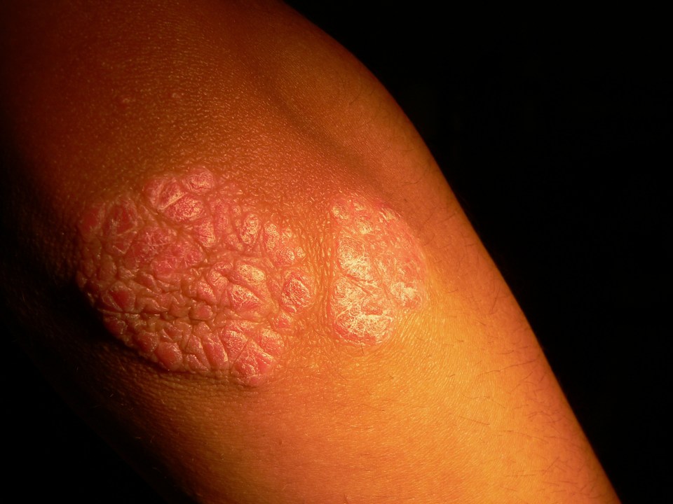  The elbow of someone suffering with psoriasis