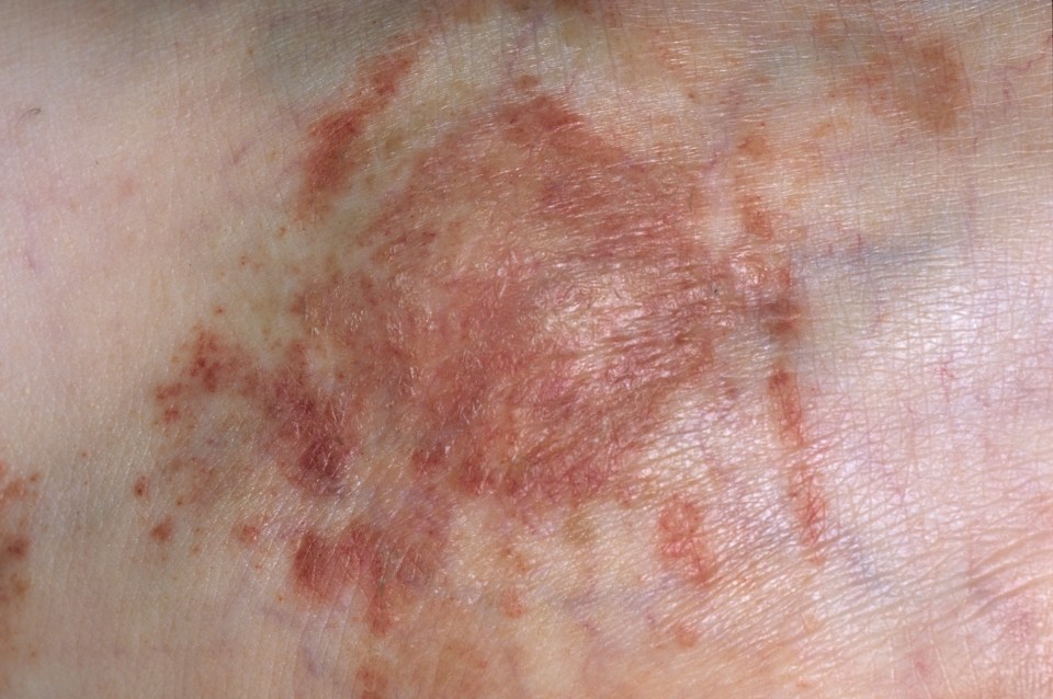  Eczema can affect anyone