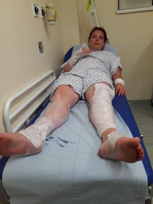  Joanne was left in agonising pain after suffering first, second and third degree burns to her hands, arms, legs and feet