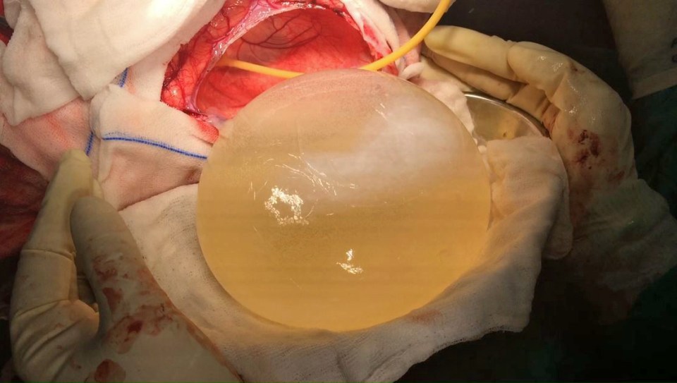  It took a two-and-a-half hour operation to remover the cyst