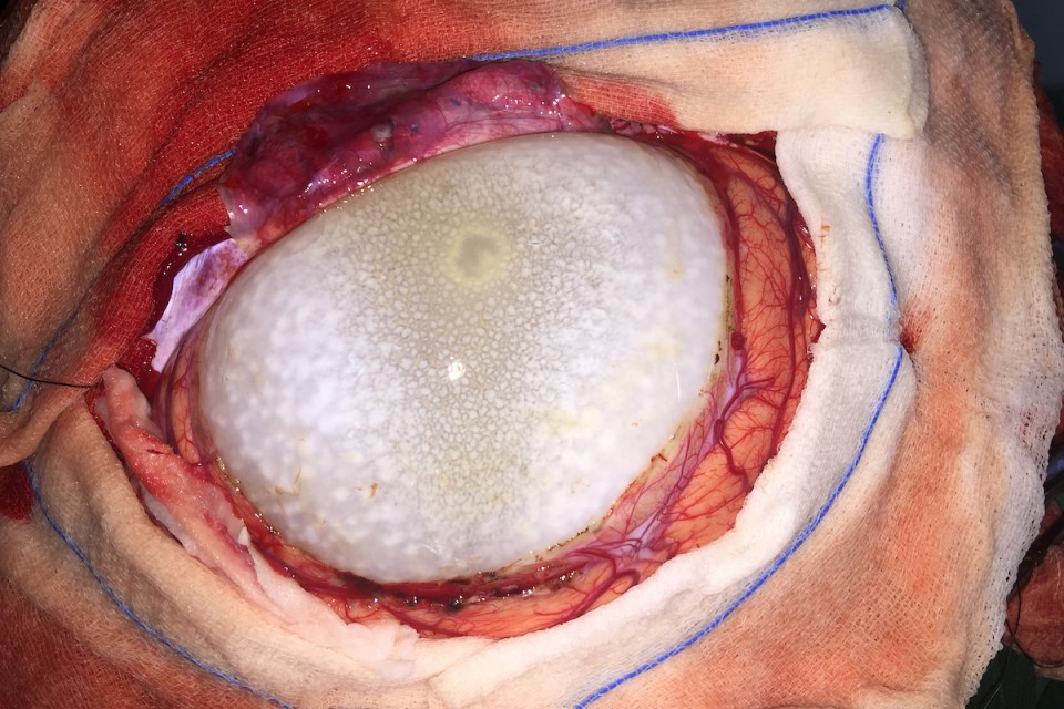  MRI scans found a cyst on Nita's brain weighing 675 grams