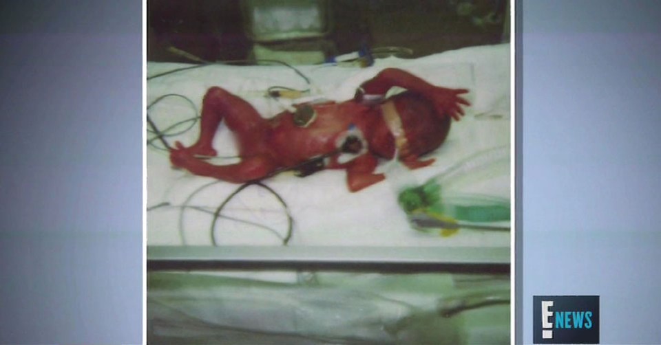  Devasha was born a staggering five months premature