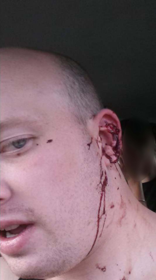  Jason Robinson needed five stitches in his ear after he was beaten up by a thug