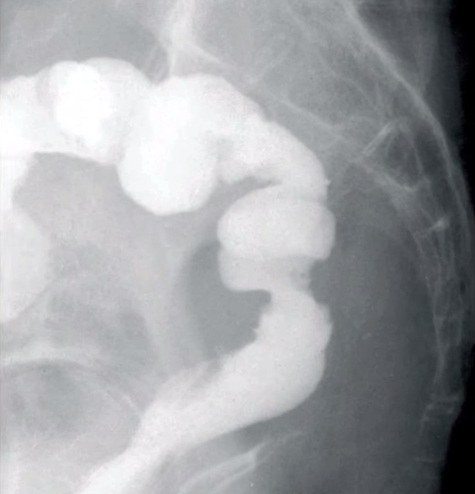  X-ray showing of the woman whose colon was accidentally connected to her private parts