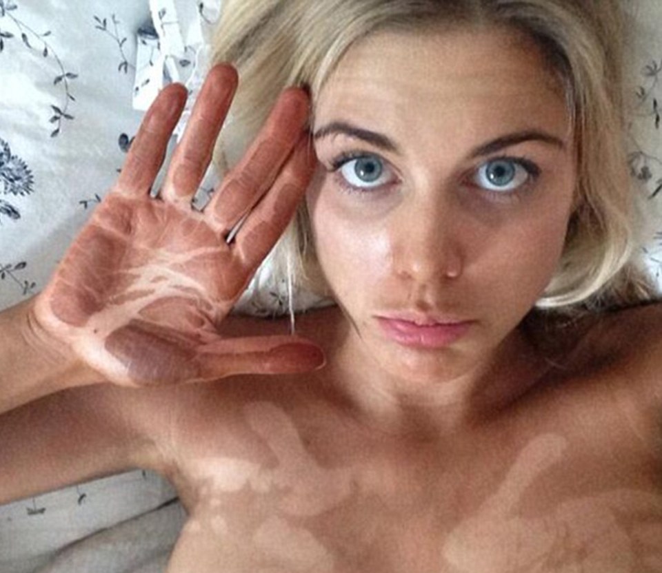  Ashley ruined her fake tan after sleeping in an unusual position