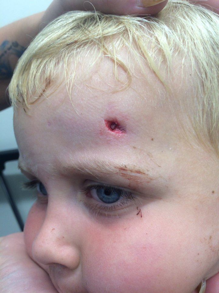  Toddler Tommy Jenkins, 3, was nearly blinded hen he impaled his head on a broken supermarket trolley rod