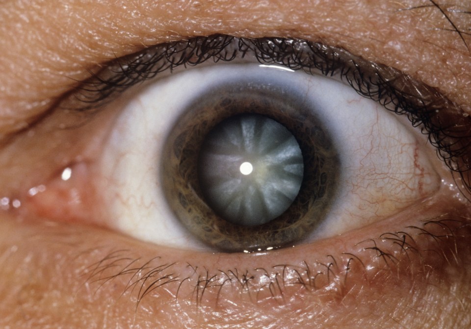  A close-up of an eye showing a cataract