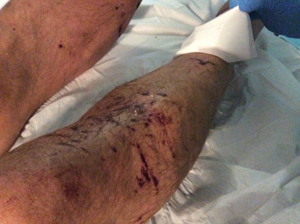  Victim of dog attack shows off wounds on his leg which have kept him in hospital for two weeks