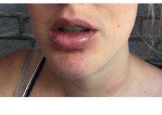  Just five weeks after the injections, Michelle started to realise something was wrong, when she noticed her lips were wonkly. Pictured after the injections, she warns others not to have the procedure