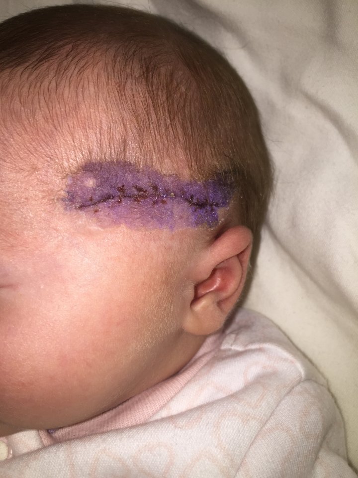  The family had to wait 24 hours for a plastic surgeon to come and stitch up the newborn's wound