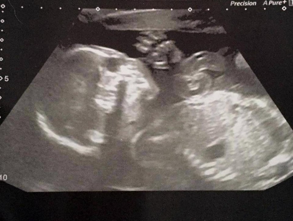  Emma's 20 week scan