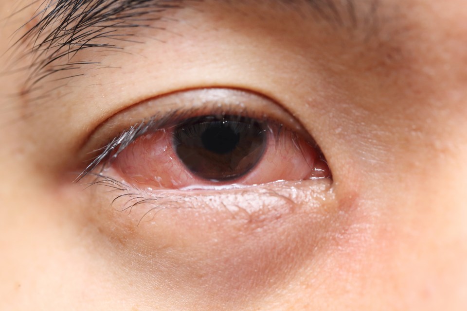  Inflamed eyes can be a sign of tonsillitis