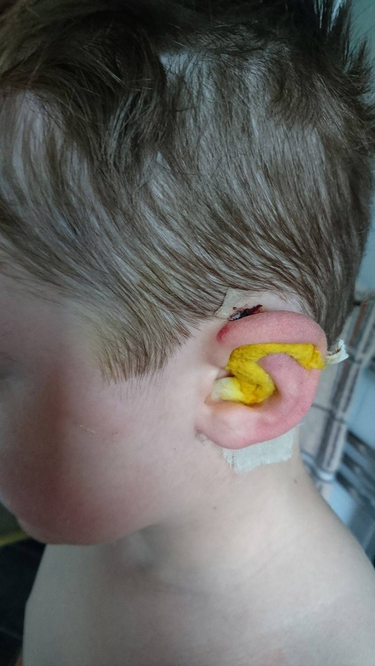  Surgeons remoulded the cartilage and inserted splints in Elwood's ears