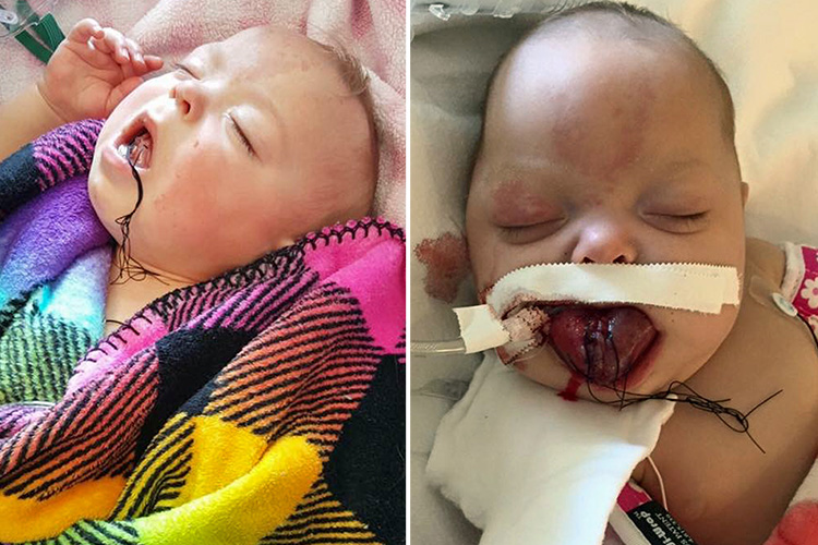  Baby Paisley had to endure two tongue reduction surgeries