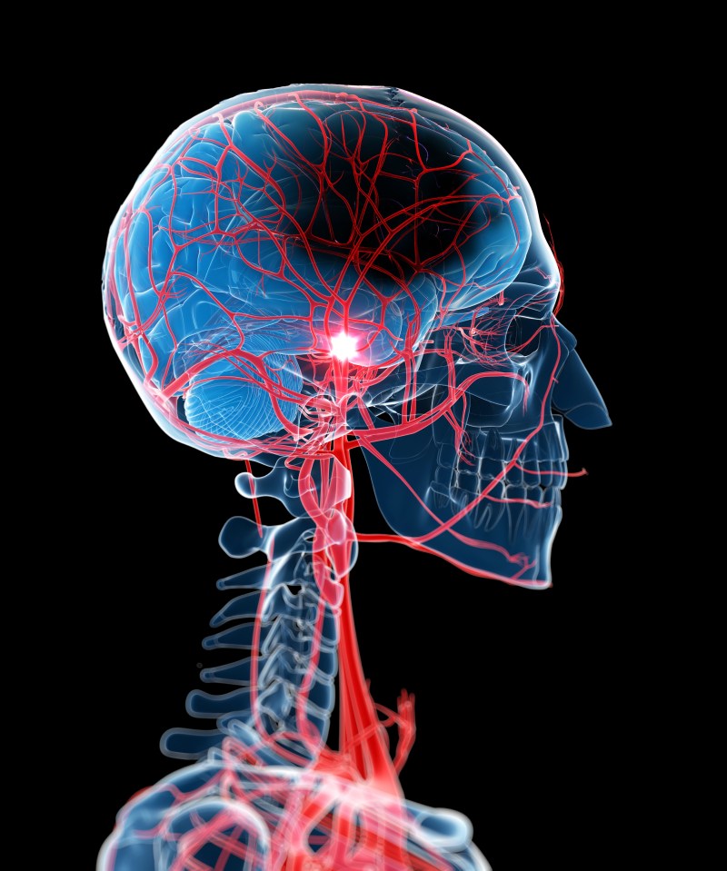  A stroke is a brain attack, and happens when the blood supply to the brain is interrupted. Blood carries oxygen to the brain, and without it brain cells will begin to die off. This is what causes the damage to other parts of the body