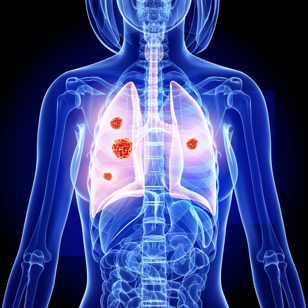 Lung cancer is the second most common type of cancer in the UK