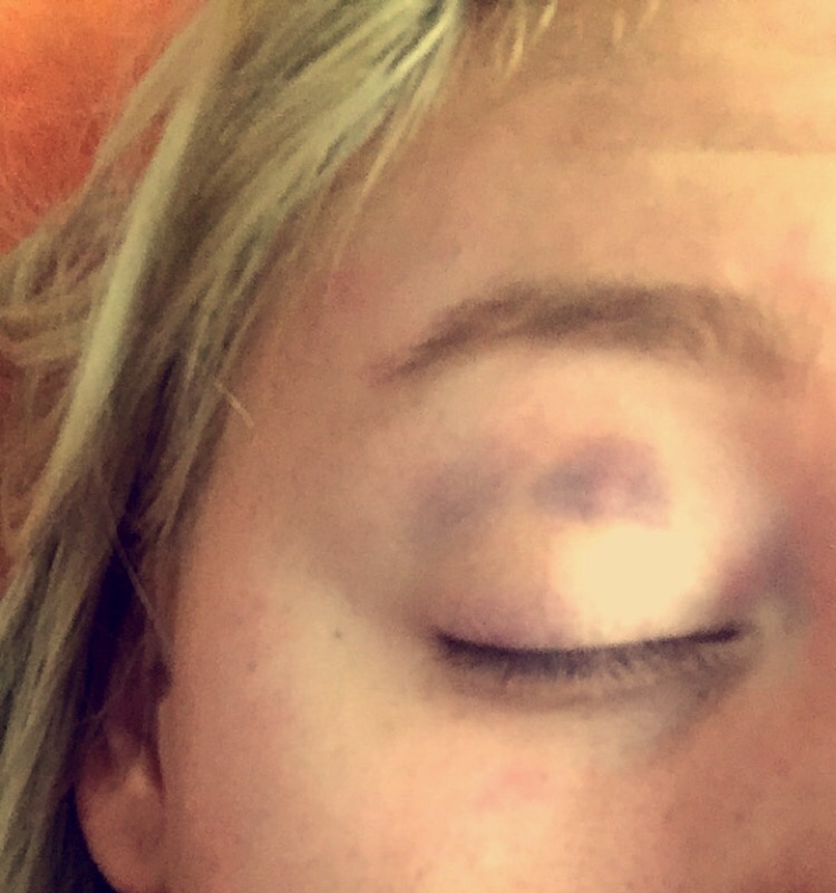  Amelia shows off a black eye