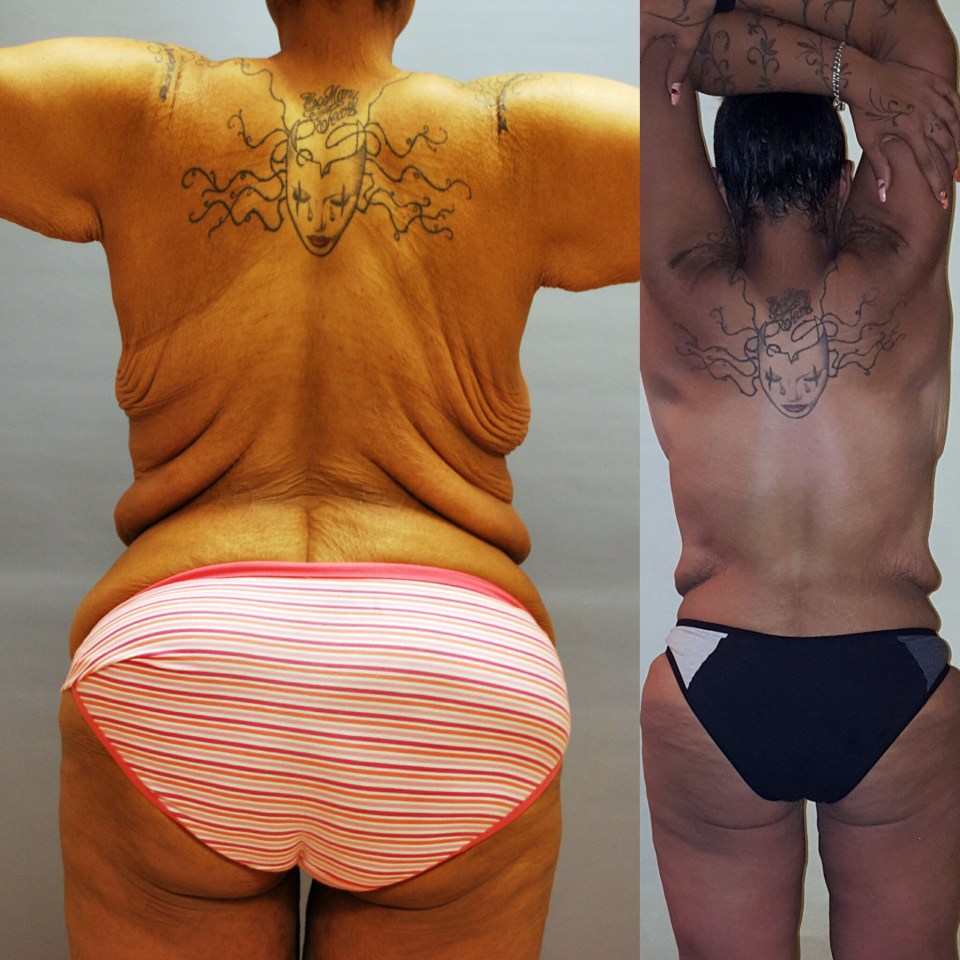  Candice's weightloss has left her with sagging skin she wants removed