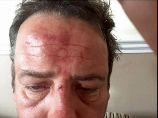  Paul Williams shows a bruised head and bloodied nose after being attacked on his doorstep