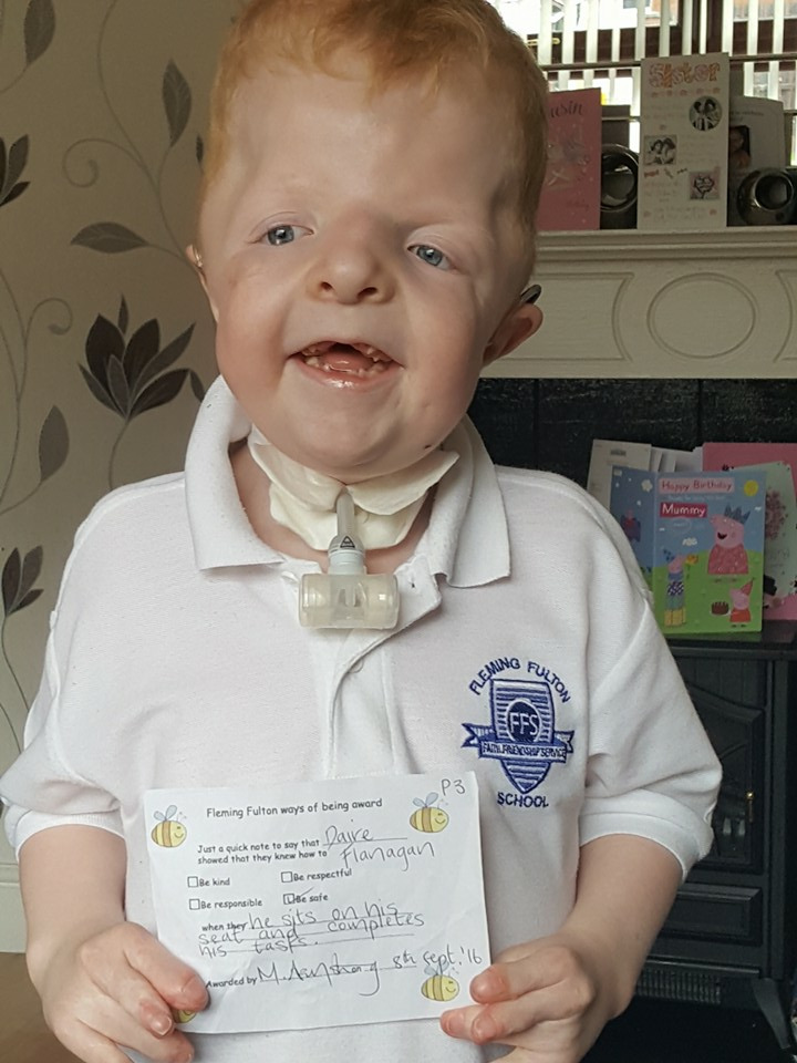  Six-year-old Daire was born with Apert Syndrome - a rare genetic condition