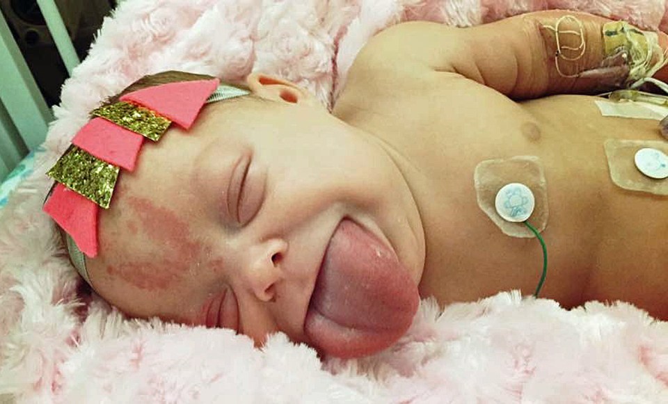  Paisley was born with Beckwith Wiedemann Syndrome (BWS) – an overgrowth disorder