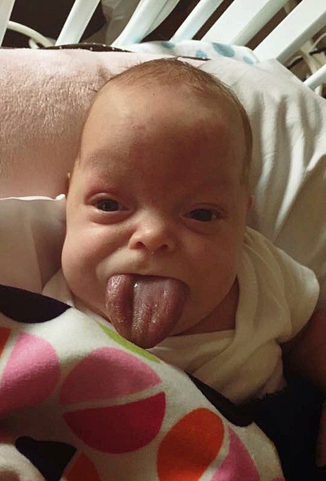  Tiny Paisley Morrison-Johnson was born with rare disorder that meant her tongue was the size of an adults