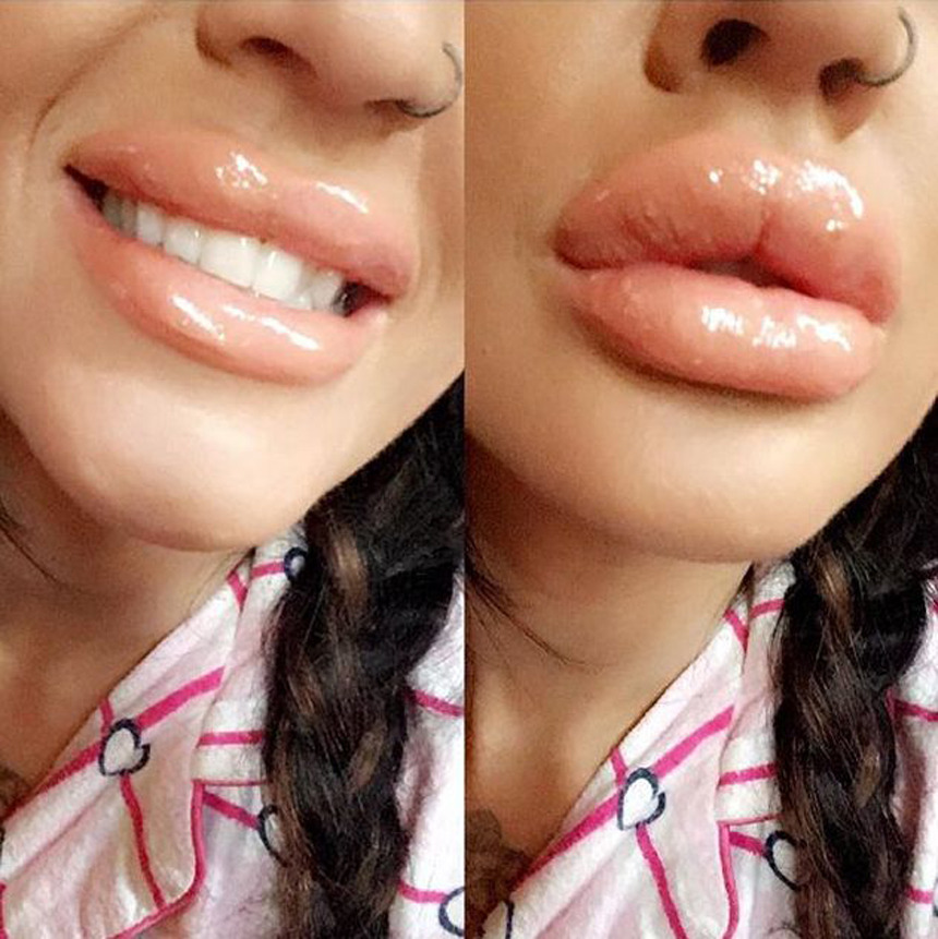  Leza's lips before and after fillers