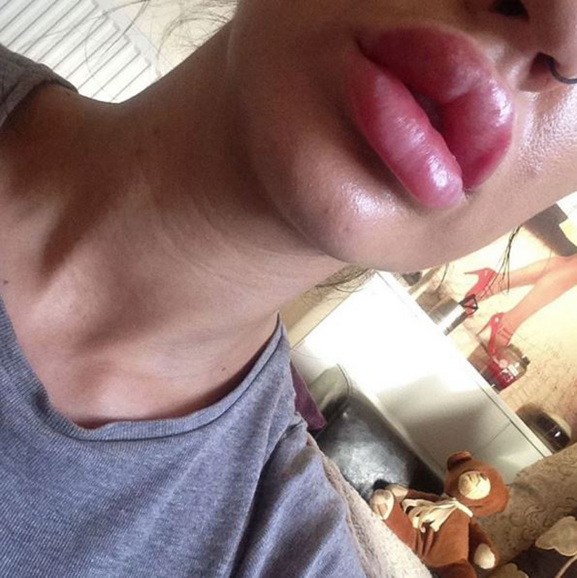  Leza's lips after her first lot of filler