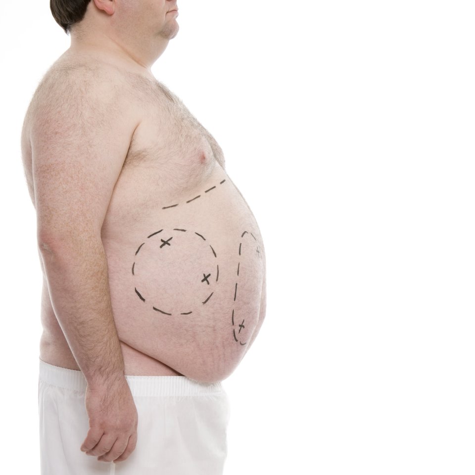  The current obesity epidemic means that a lot of future surgery will be on patients who have lost a lot of weight