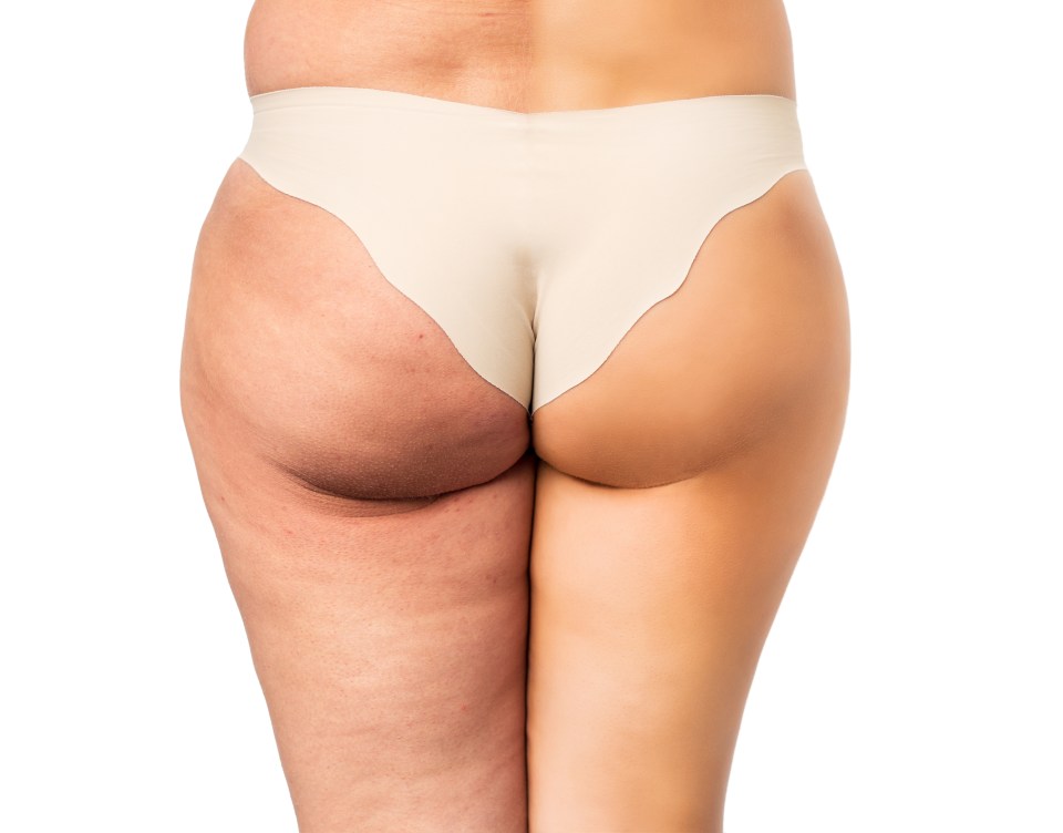  Cellulite reportedly affects 95% of women