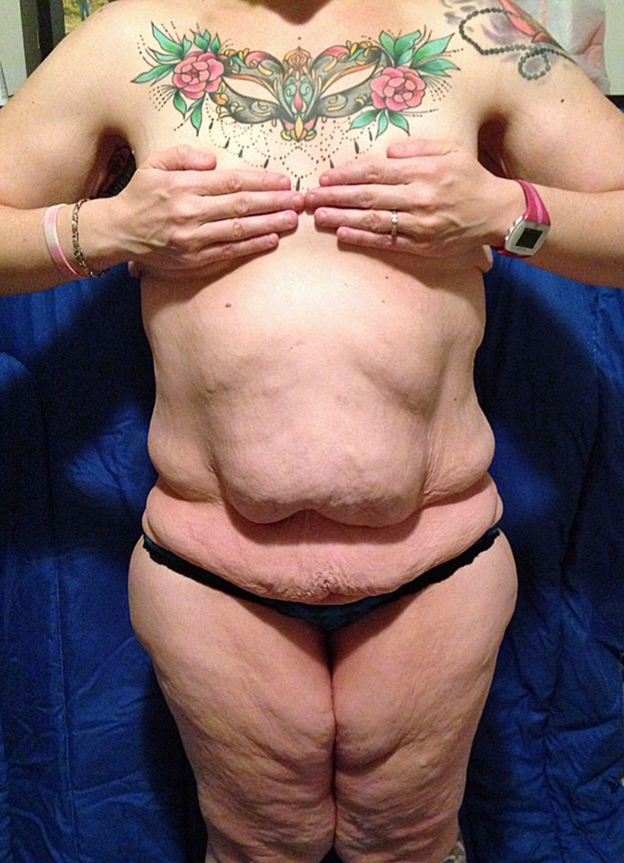  The weight loss left Beckah with excess loose skin