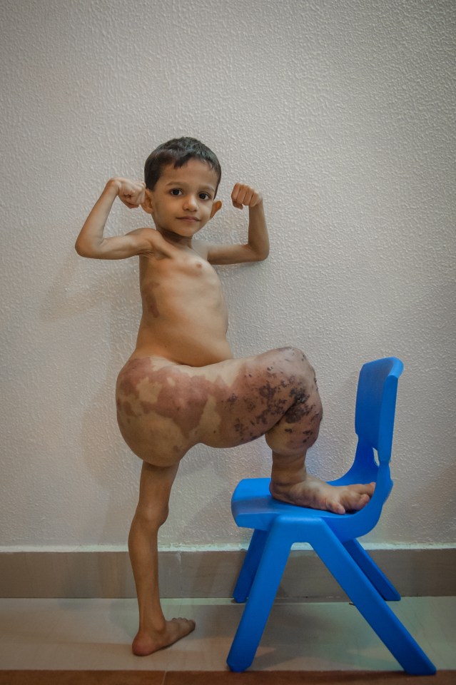 Toddler¿s Leg Has Swelled To Four Times The Size - And Still Growing