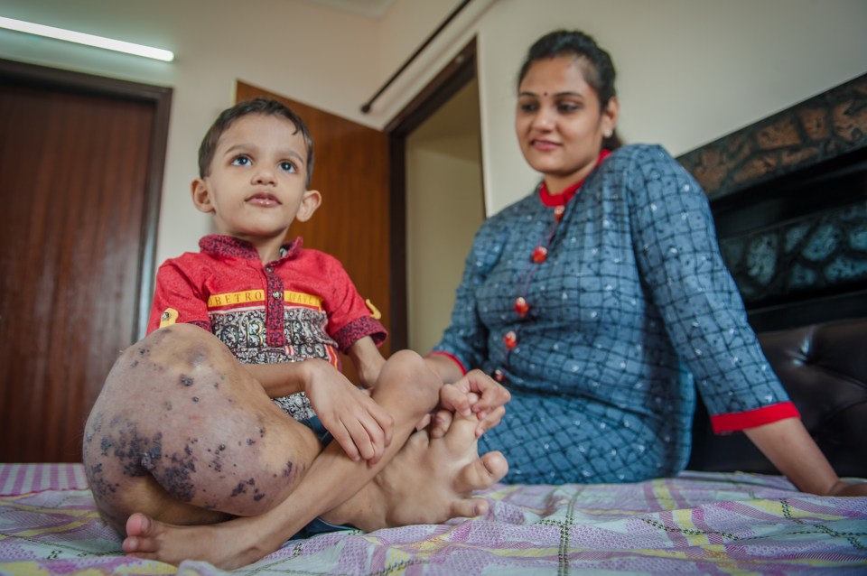 Toddler¿s Leg Has Swelled To Four Times The Size - And Still Growing