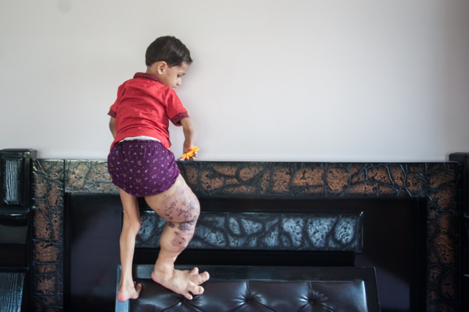 Toddler¿s Leg Has Swelled To Four Times The Size - And Still Growing