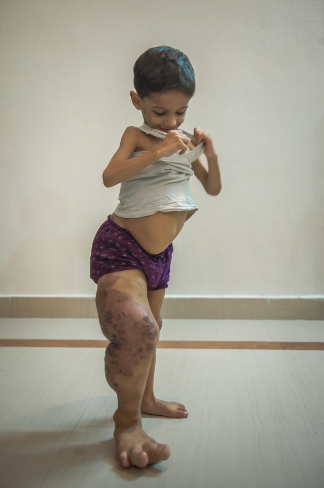 Toddler¿s Leg Has Swelled To Four Times The Size - And Still Growing