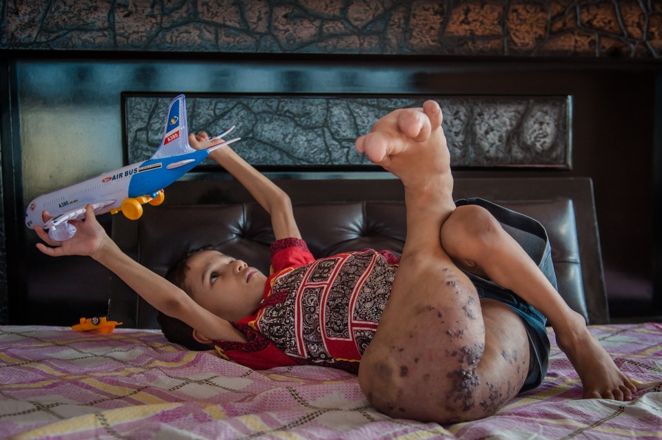 Toddler¿s Leg Has Swelled To Four Times The Size - And Still Growing