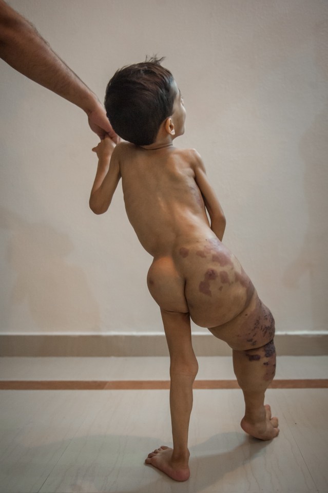 Toddler¿s Leg Has Swelled To Four Times The Size - And Still Growing