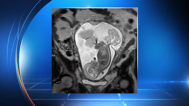  The scan shows a huge tumour growing from Linley's tailbone