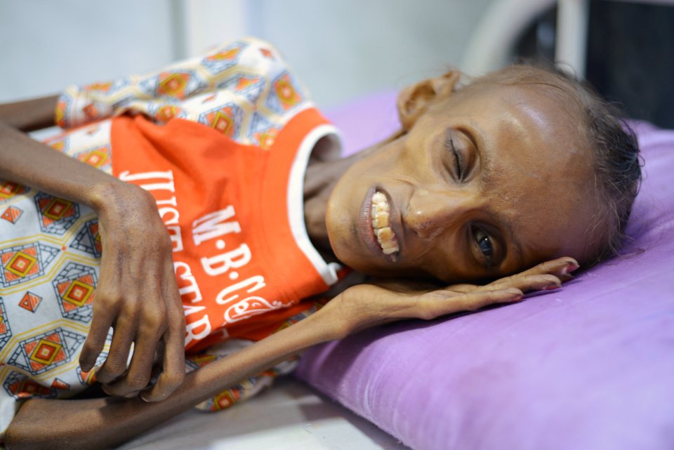  Three million Yemenis are in need of nutrition assistance