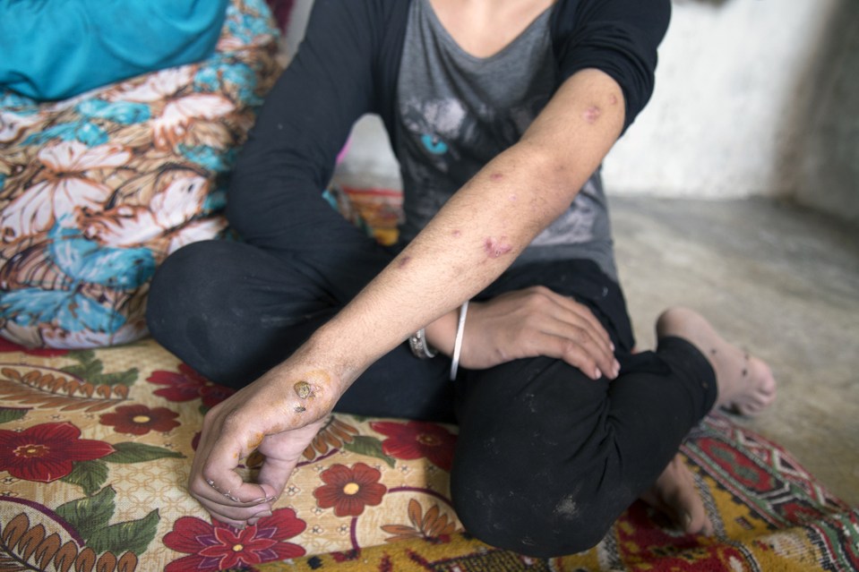  Muna, 10, shows injuries on her arm that she sustained when a booby-trap exploded outside