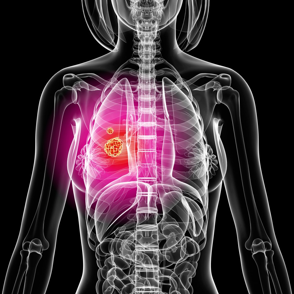  Lung cancer is the second most common type of the disease in the UK