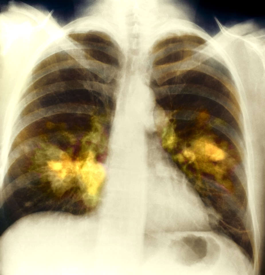  Lung cancer involves the uncontrolled growth of abnormal cells