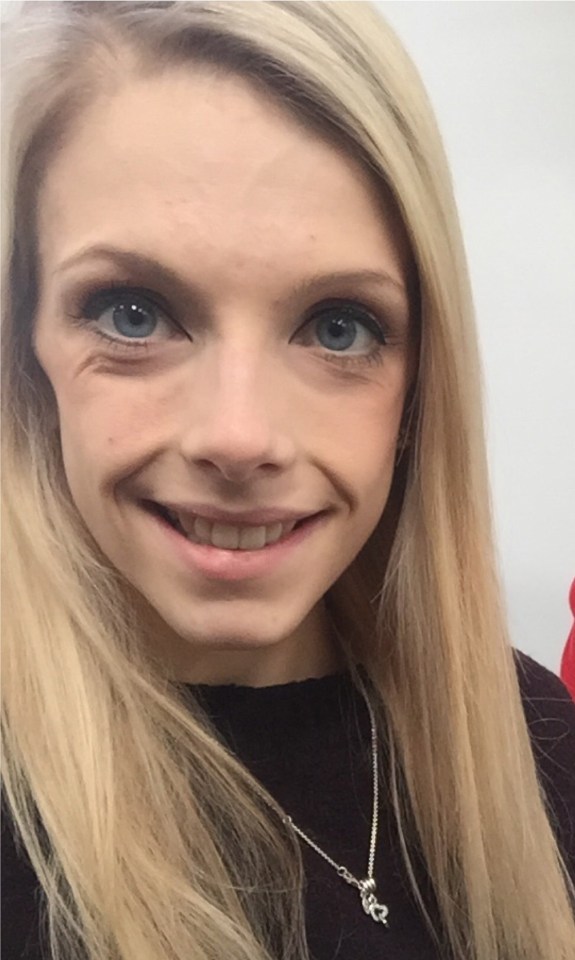  Jodie-Leighs skeletal face as anorexia took its hold on her body