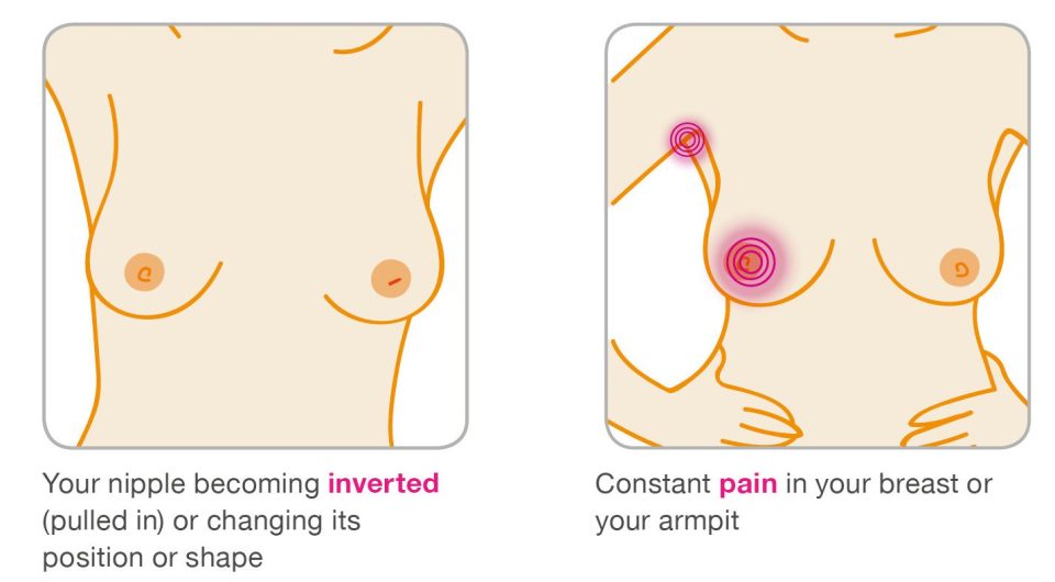  An inverted nipple is another symptom you could be missing