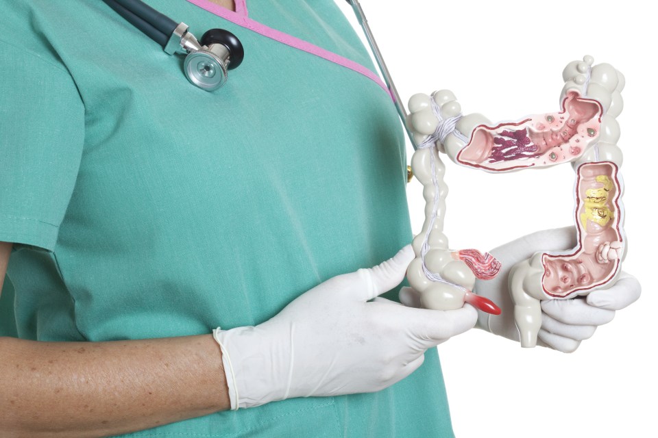 Nurse holding an anatomically correct model of large intestine- where colitis affects the body