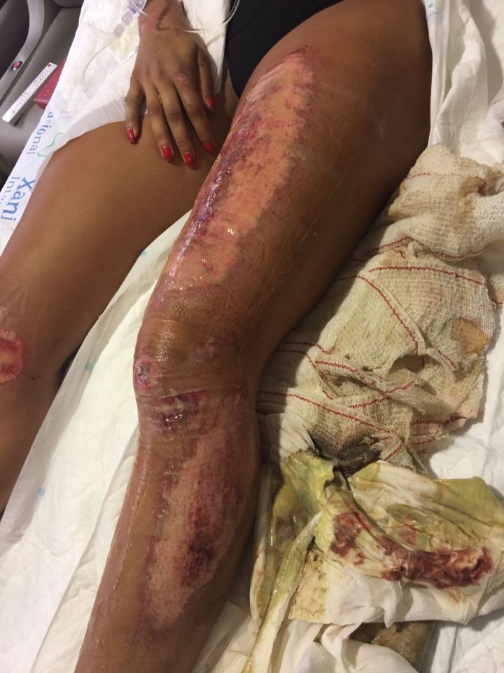 Zamara was left with burns on 35 per cent of her body after being thrown across the road 