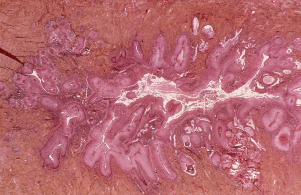  As the number of women taking up smear tests falls, the number of people being diagnosed with cervical cancer, pictured under the microscope, is increasing